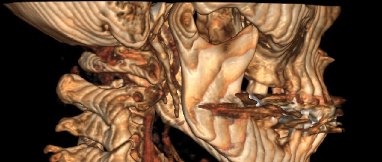 CT scan 3D reconstruction example